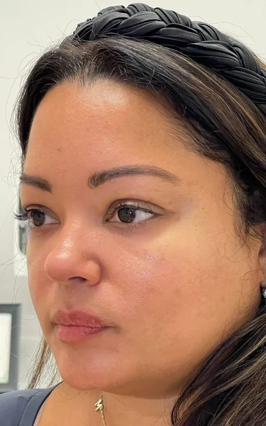 Cheek Filler, before treatment