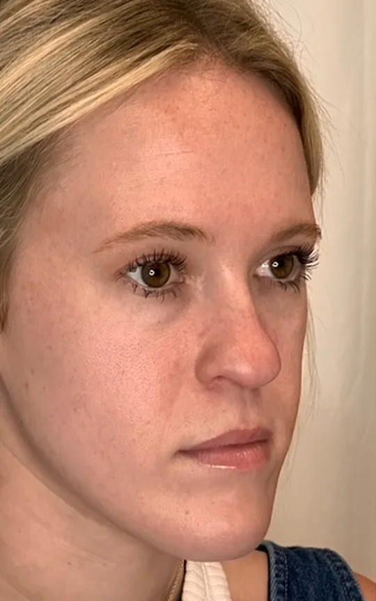 Cheek Lift, before treatment