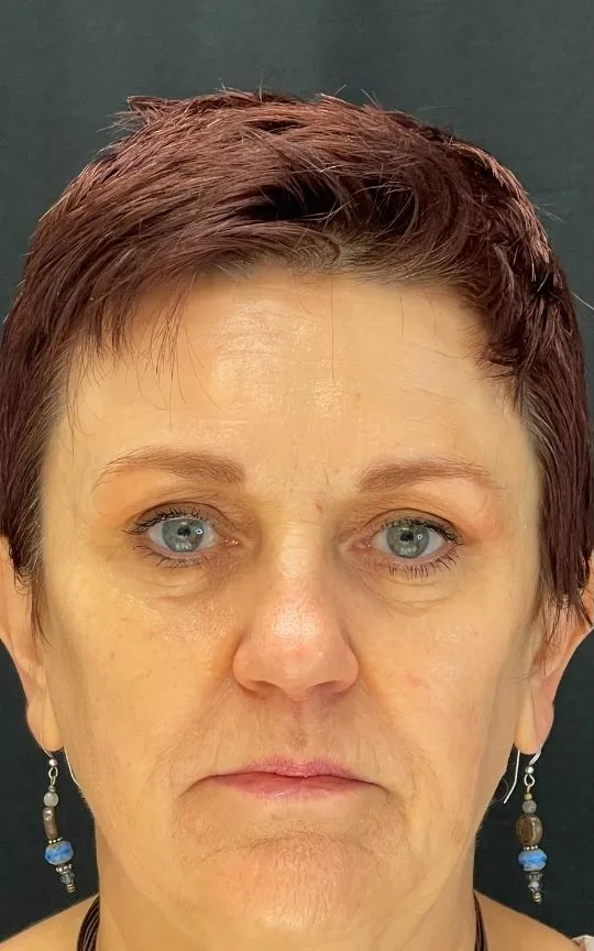 Botox and Dermal Filler, before treatment