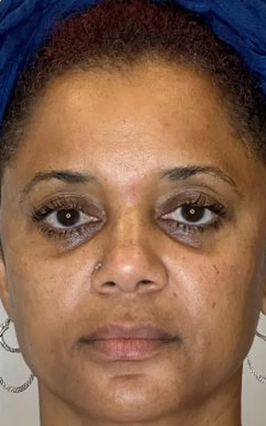 Nonsurgical Facelift, before treatment
