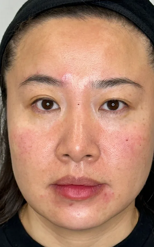 Full Facial Balancing, after treatment