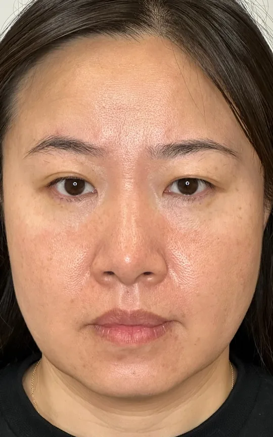 Full Facial Balancing, before treatment