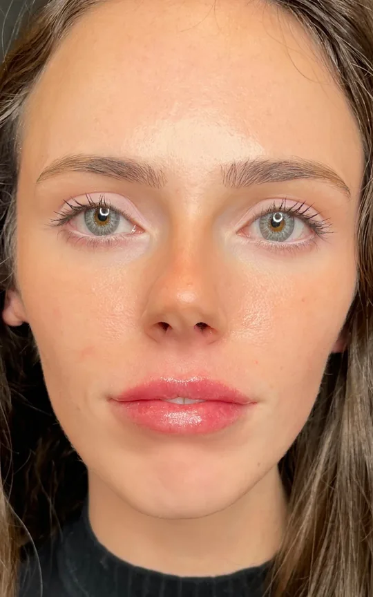 Lip Treatment, after treatment
