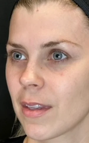 Lips and Facial Balancing Using Fillers, before treatment