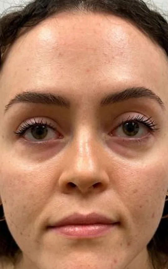 Tear Trough (Under Eye), before treatment